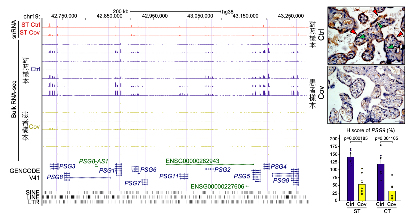 Samples of COVID-19 patients show the loss of PSG proteins in placental cells and reduced PSG gene expression, which could affect the placental development.