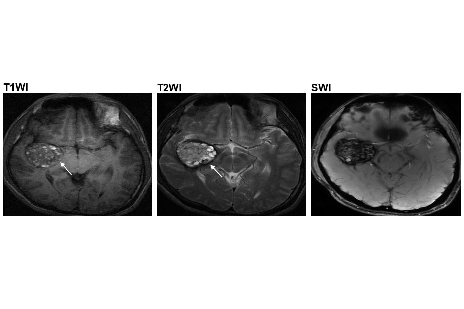 The popcorn-like lesions (as indicated by the arrows) in the brain arteries of type II CCM patients.